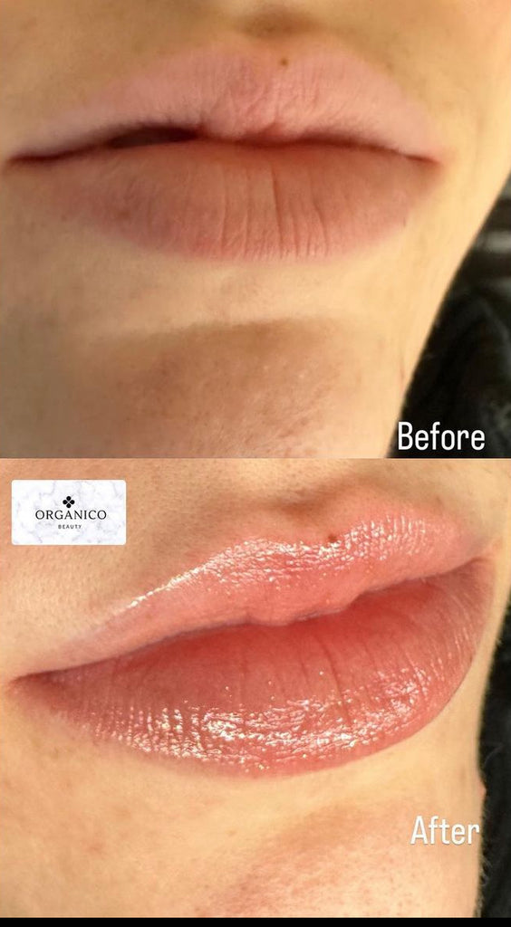 Aerolase Lip Enhancement