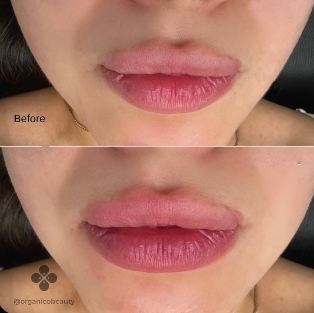 Aerolase Lip Enhancement