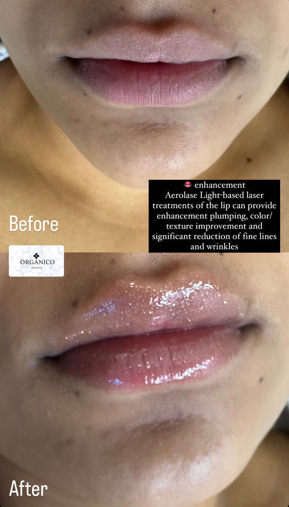 Aerolase Lip Enhancement