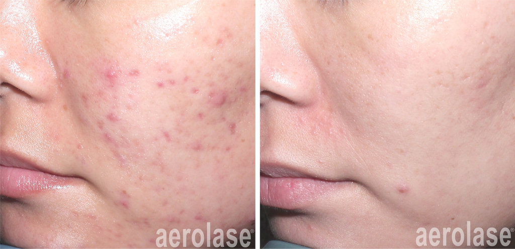 Aerolase acné treatment & Scar