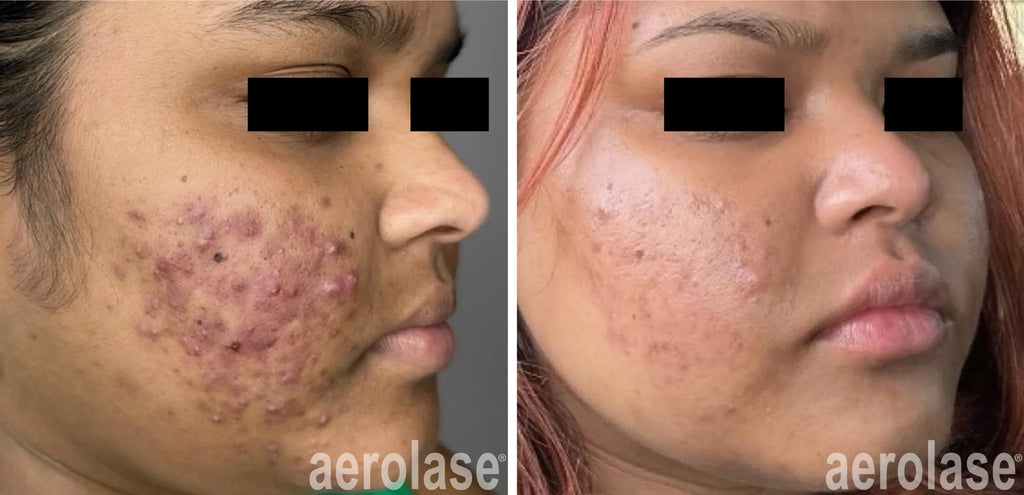 Aerolase acné treatment & Scar