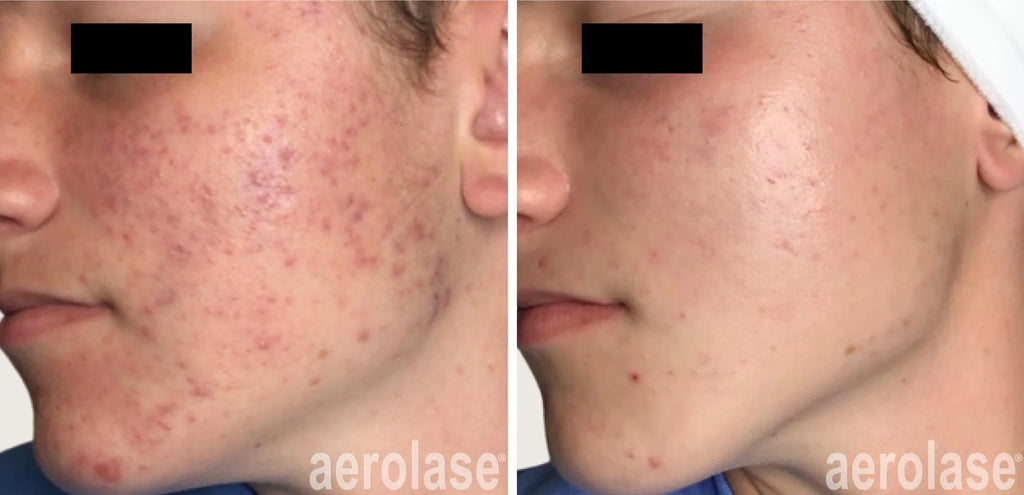 Aerolase acné treatment & Scar