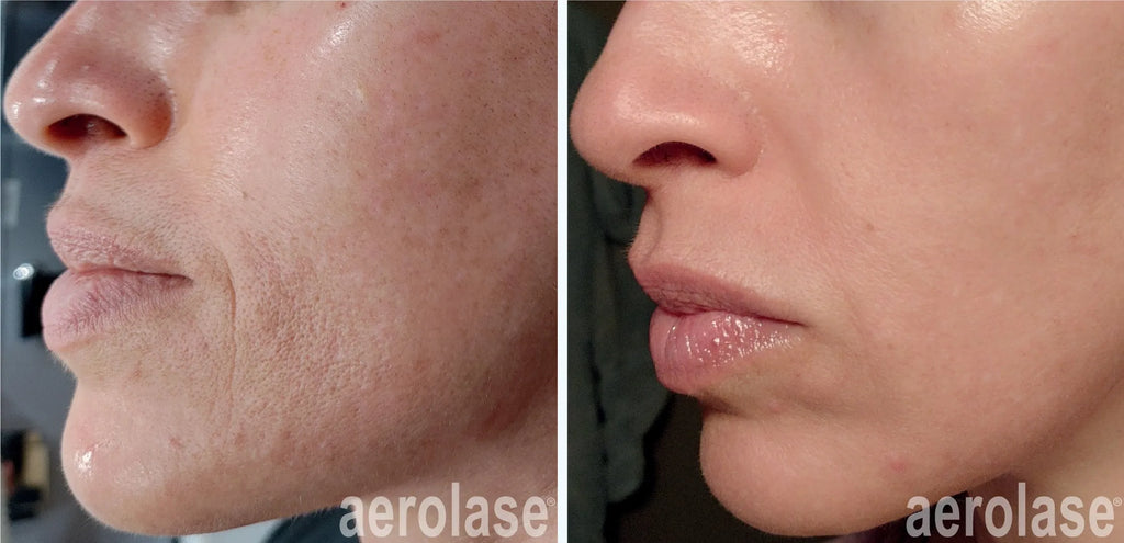 Aerolase® Skin Rejuvenation & Tightening