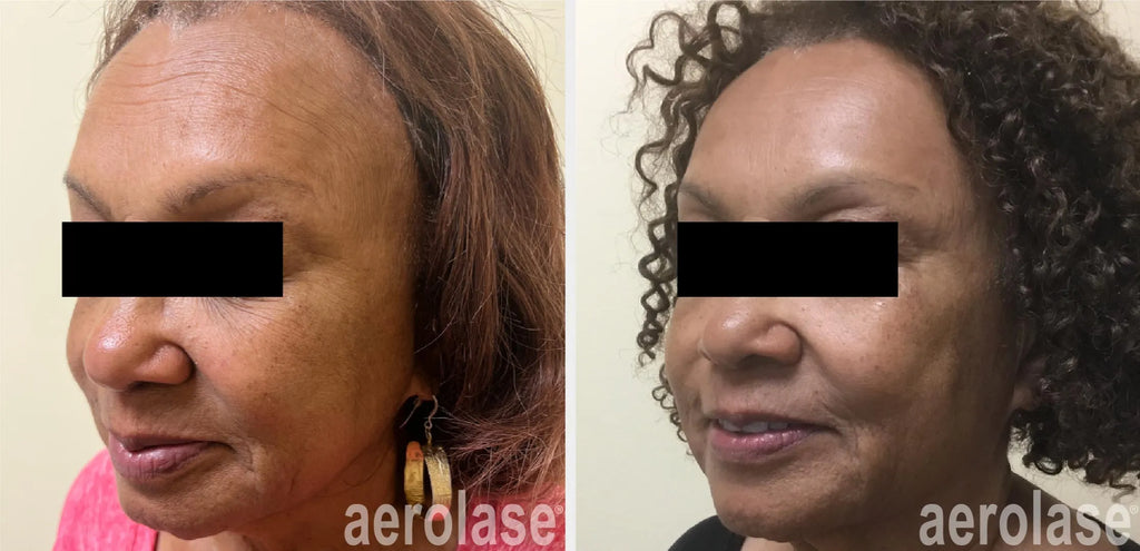 Aerolase® Skin Rejuvenation & Tightening