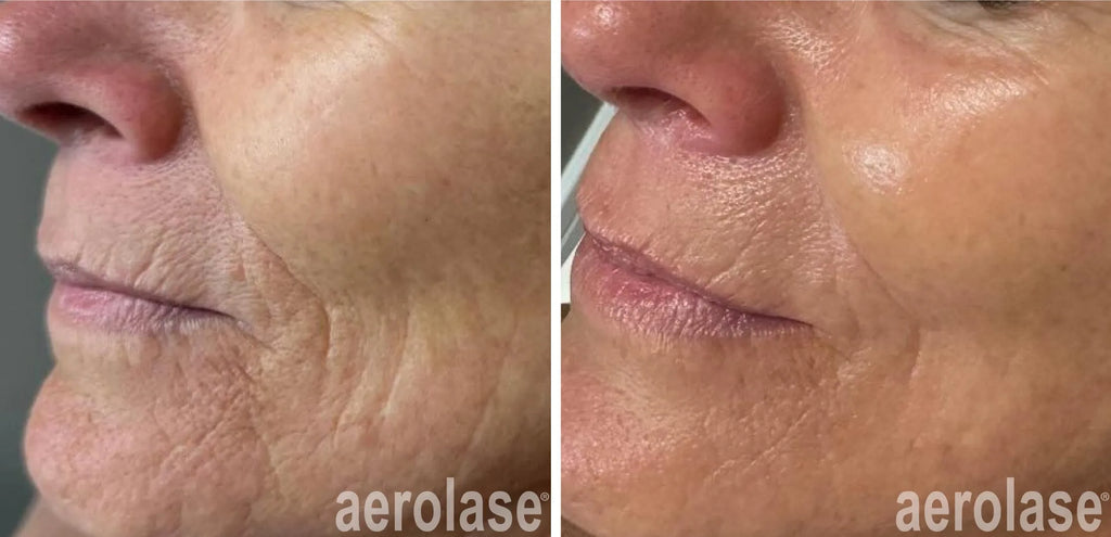 Aerolase® Skin Rejuvenation & Tightening