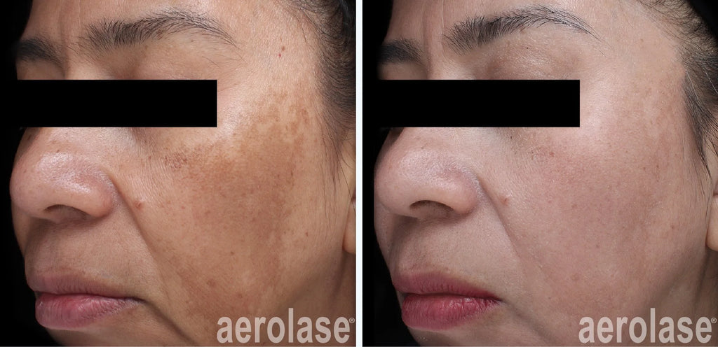 Aerolase Hyperpigmentation & Melasma Treatment