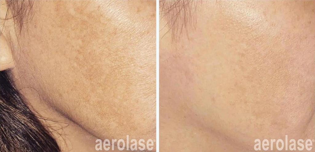 Aerolase Hyperpigmentation & Melasma Treatment