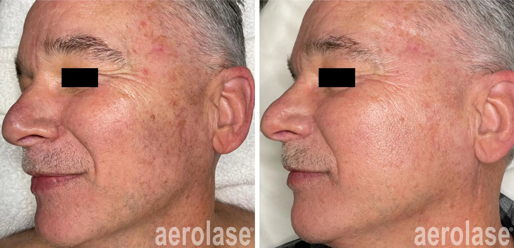 Aerolase® Skin Rejuvenation & Tightening