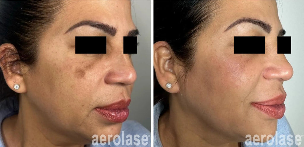 Aerolase Hyperpigmentation & Melasma Treatment