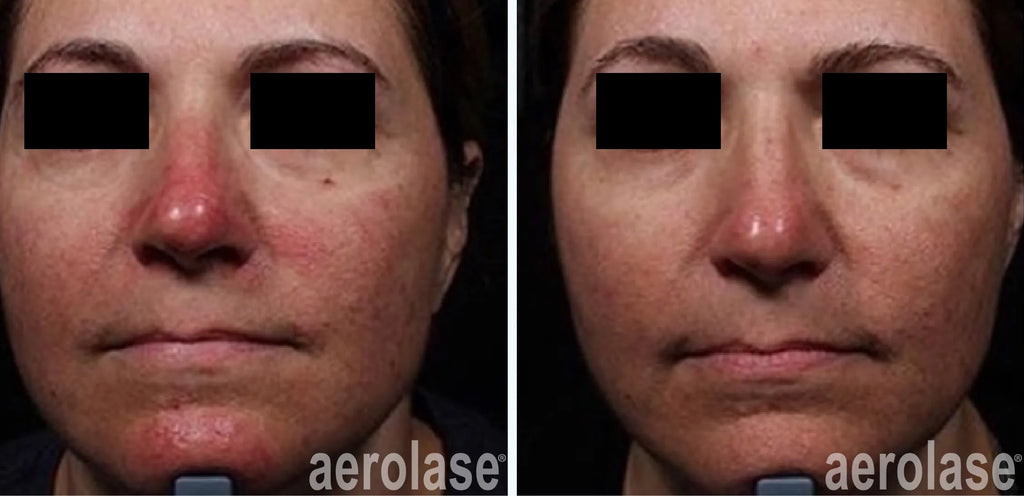 Aerolase Rosacea Treatment