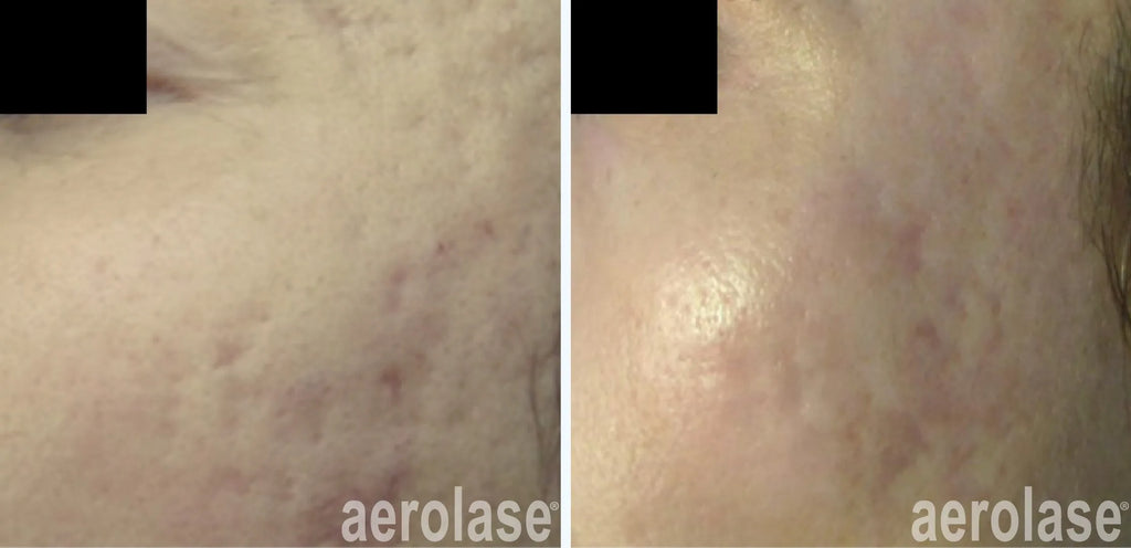 Aerolase acné treatment & Scar