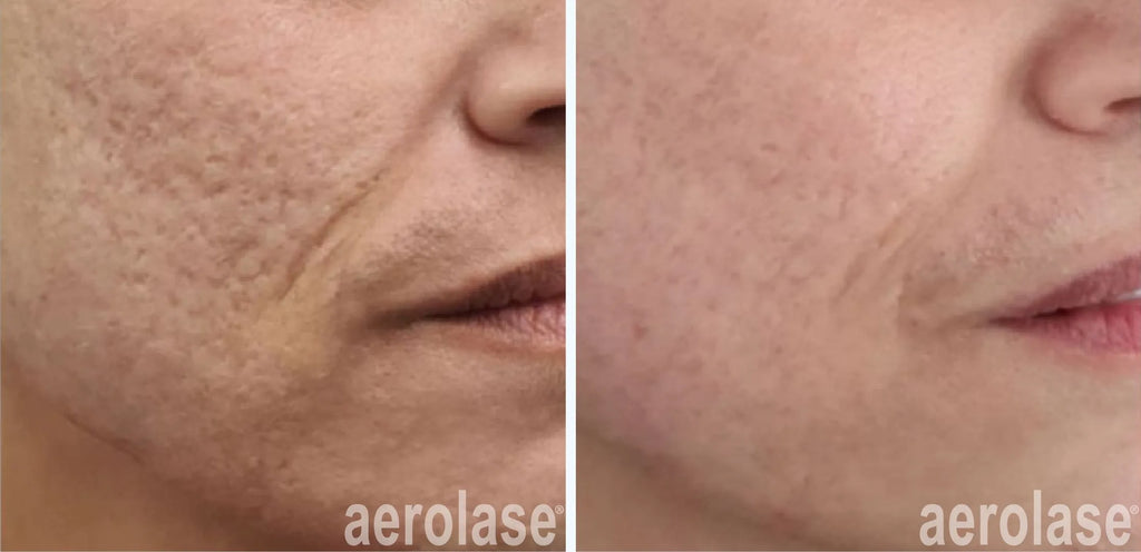 Aerolase acné treatment & Scar